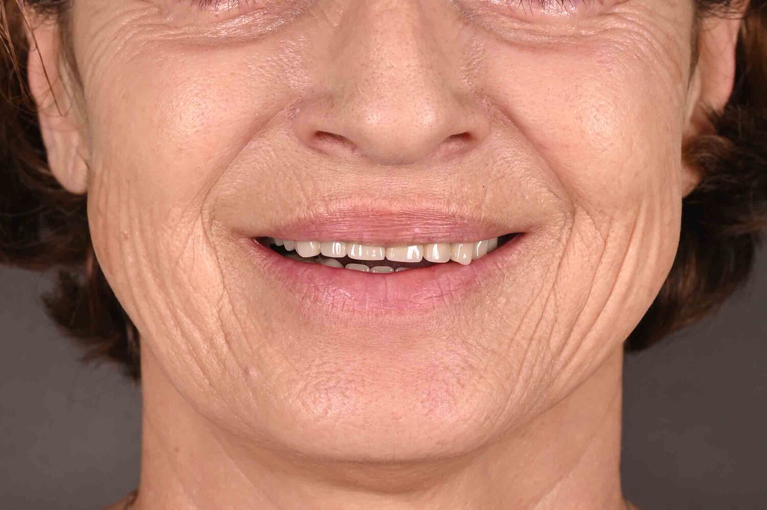 Pacient Clinica Dr. Alin Odor - Rezultat Implantologie